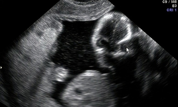 Abortowane dziecko cierpi: chlorek potasu podawany bez znieczulenia przynosi "potworny ból"