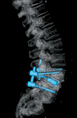 Zdjęcia rentgenowskie  kręgosłupa po repozycji i stabilizacji trzonów. Jego właścicielka zaczęła odzyskiwać sprawność już w drugiej  dobie po zabiegu