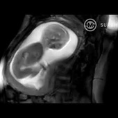 Incredible MRI Footage of a Baby in the Womb taken by iFIND Project