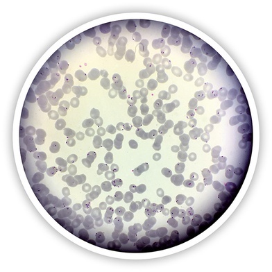 Obraz mikroskopowy pierwotniaka wywołującego malarię, atakującego  czerwone krwinki  człowieka.