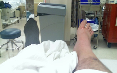 Pacjent po przeszczepie nóg za pół roku ma chodzić