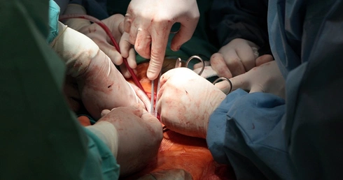 Pierwszy w Polsce przeszczep wątroby u pacjenta z HIV