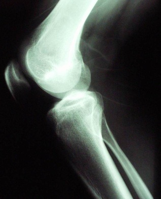 Zdjęcie rentgenowskie stawu kolanowego