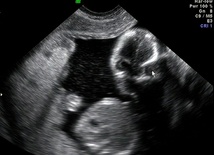 Abortowane dziecko cierpi. Chlork potasu powoduje potworny ból