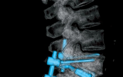 Zdjęcia rentgenowskie  kręgosłupa po repozycji i stabilizacji trzonów. Jego właścicielka zaczęła odzyskiwać sprawność już w drugiej  dobie po zabiegu