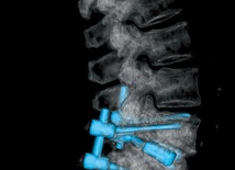 Zdjęcia rentgenowskie  kręgosłupa po repozycji i stabilizacji trzonów. Jego właścicielka zaczęła odzyskiwać sprawność już w drugiej  dobie po zabiegu
