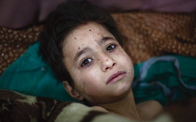 10.03.2016.Damaszek.Syria. Chłopiec ranny po bombardowaniu Dumy, miasta w pobliżu Damaszku. W wyniku bombardowania zginęło  co najmniej sześć osób. Nie wiadomo, kto zaatakował i kto był celem.