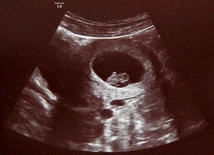 W łonie matki ratują życie