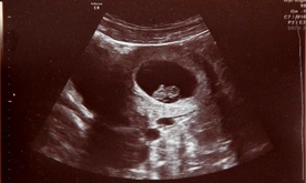 W łonie matki ratują życie