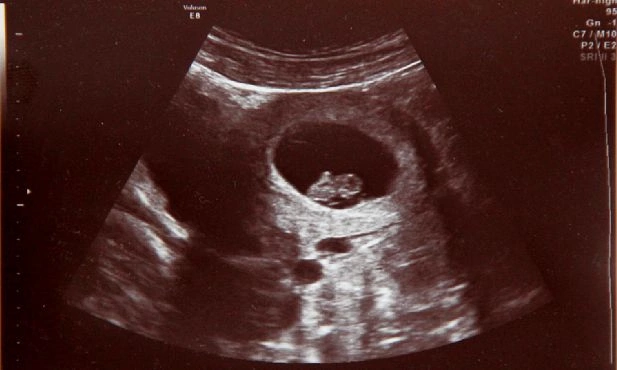 W łonie matki ratują życie