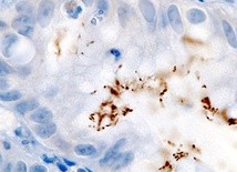 Helicobacter pylori wykryty metodą immunochemiczną