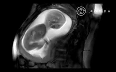 Incredible MRI Footage of a Baby in the Womb taken by iFIND Project