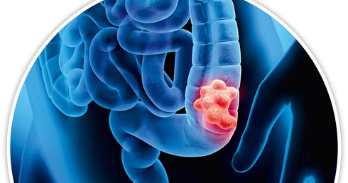 Na nowotwory jelita grubego każdego roku cierpi w Polsce kilkanaście tysięcy osób. Przeżywa nie więcej niż połowa.