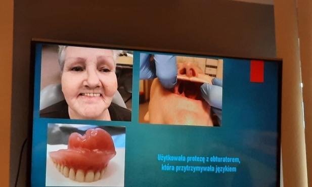 Katowice. Niezwykłe zabiegi z zakresu chirurgii twarzowo-szczękowej w Szpitalu im. Mielęckiego