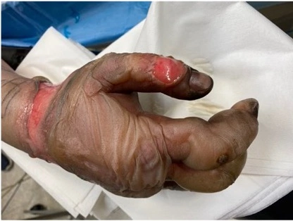 Region. Pilnujmy dzieci na grillu – apelują lekarze z GCZD w Katowicach