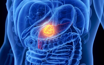 Od lat nie mieliśmy w raku trzustki takiego przełomu - mówi prof. Wyrwicz z Narodowego Instytutu Onkologii
