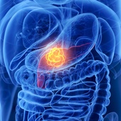 Od lat nie mieliśmy w raku trzustki takiego przełomu - mówi prof. Wyrwicz z Narodowego Instytutu Onkologii